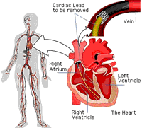 Lead Extraction